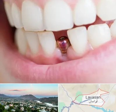 ایمپلنت اقساطی در لواسان