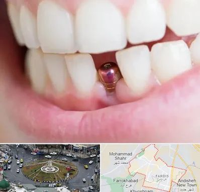 ایمپلنت اقساطی در فردیس کرج 