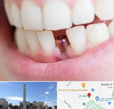 ایمپلنت اقساطی در فلکه گاز شیراز