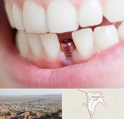 ایمپلنت اقساطی در اسفراین