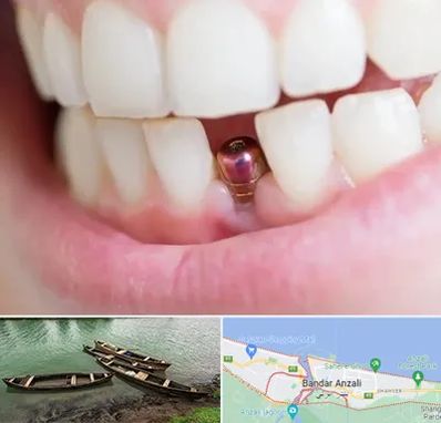ایمپلنت اقساطی در بندر انزلی