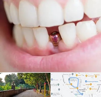 ایمپلنت اقساطی در فلکه گاز رشت