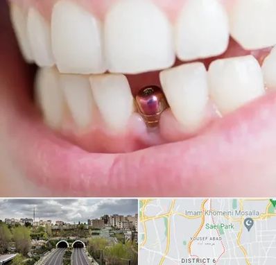 ایمپلنت اقساطی در یوسف آباد 