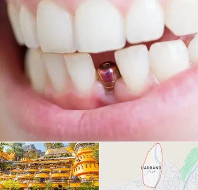 ایمپلنت اقساطی در دربند