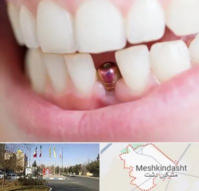 ایمپلنت اقساطی در مشکین دشت