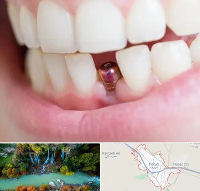 ایمپلنت اقساطی در دورود