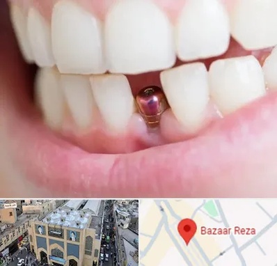 ایمپلنت اقساطی در بازار رضا مشهد