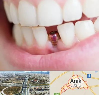 ایمپلنت اقساطی در اراک