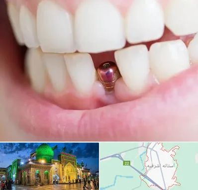 ایمپلنت اقساطی در آستانه اشرفیه