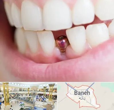 ایمپلنت اقساطی در بانه
