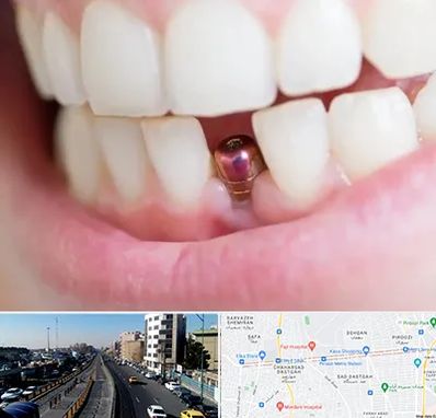 ایمپلنت اقساطی در پیروزی 