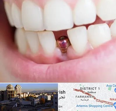 ایمپلنت اقساطی در فرمانیه 