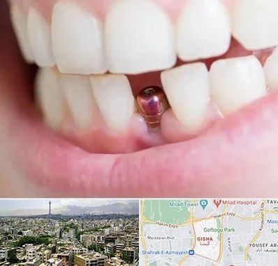 ایمپلنت اقساطی در گیشا 