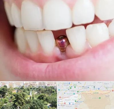 ایمپلنت اقساطی در منطقه 13 تهران 