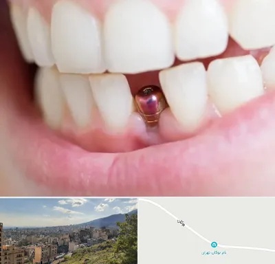 ایمپلنت اقساطی در بوکان تهران