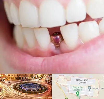 ایمپلنت اقساطی در بهارستان