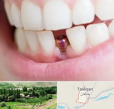 ایمپلنت اقساطی در طالقان