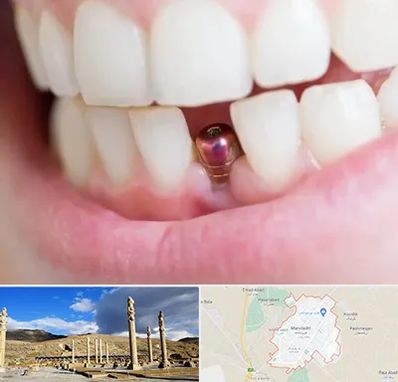 ایمپلنت اقساطی در مرودشت