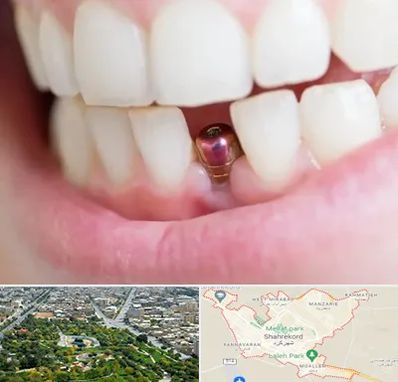 ایمپلنت اقساطی در شهرکرد