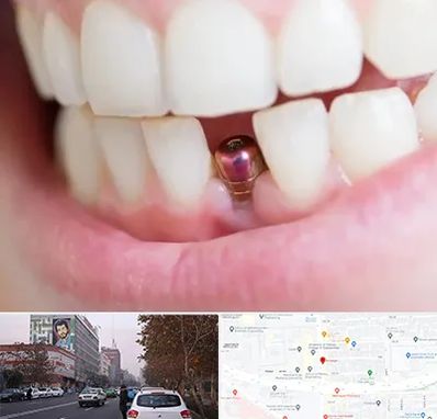 ایمپلنت اقساطی در کارگر شمالی 