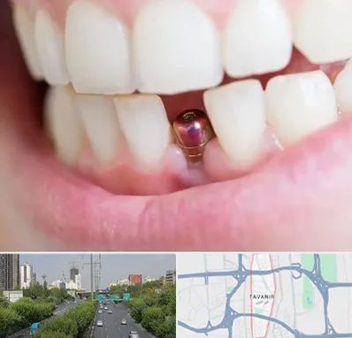 ایمپلنت اقساطی در توانیر