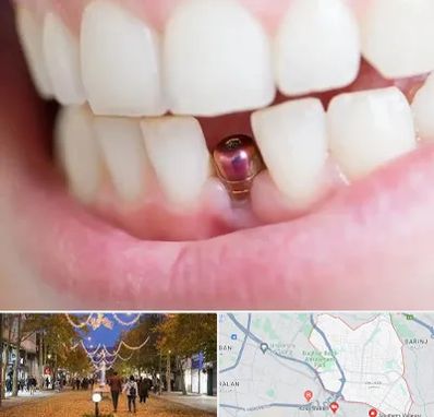 ایمپلنت اقساطی در ولیعصر ارومیه