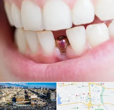 ایمپلنت اقساطی در شهرک راه آهن 