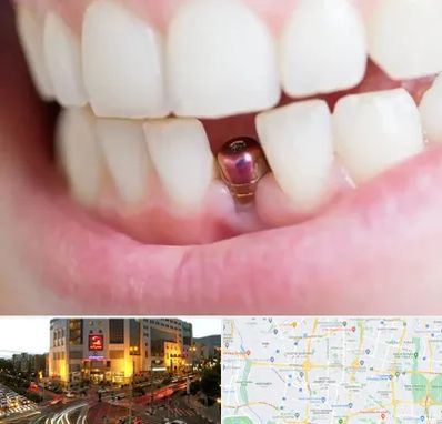 ایمپلنت اقساطی در جنت آباد تهران 