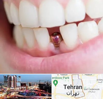 ایمپلنت اقساطی در صادقیه 