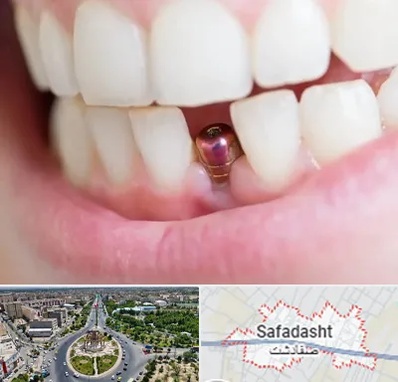 ایمپلنت اقساطی در صفادشت