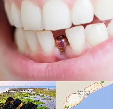 ایمپلنت اقساطی در بندرلنگه