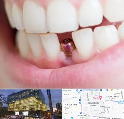 ایمپلنت اقساطی در جمهوری 