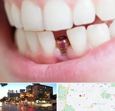 ایمپلنت اقساطی در بلوار سجاد مشهد 