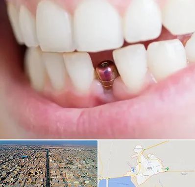 ایمپلنت اقساطی در بندر ماهشهر