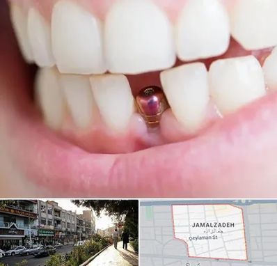 ایمپلنت اقساطی در خیابان جمالزاده