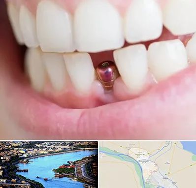 ایمپلنت اقساطی در خرمشهر