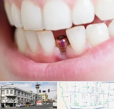 ایمپلنت اقساطی در 17شهریور