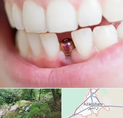 ایمپلنت اقساطی در آزادشهر