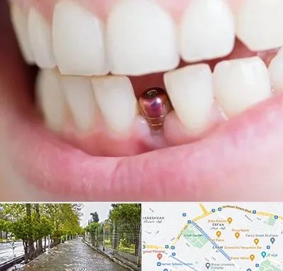 ایمپلنت اقساطی در خیابان ارم شیراز