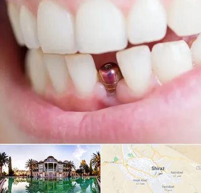 ایمپلنت اقساطی در شیراز