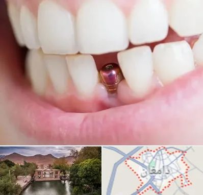 ایمپلنت اقساطی در دامغان
