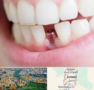 ایمپلنت اقساطی در اردبیل
