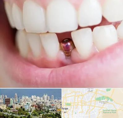 ایمپلنت اقساطی در شرق تهران 