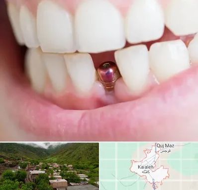 ایمپلنت اقساطی در کلاله