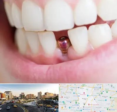 ایمپلنت اقساطی در منطقه 7 تهران 