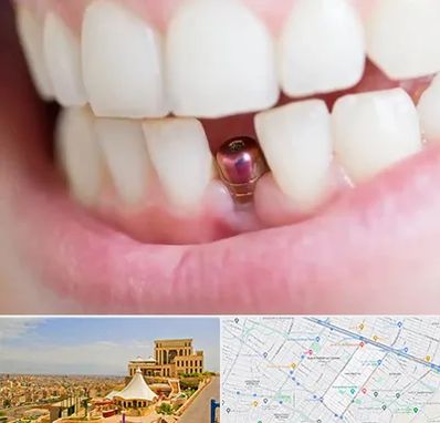 ایمپلنت اقساطی در هاشمیه مشهد