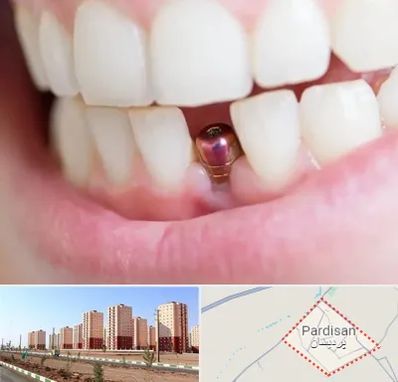ایمپلنت اقساطی در پردیسان قم