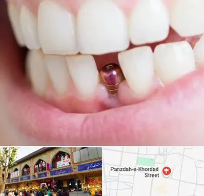 ایمپلنت اقساطی در 15 خرداد