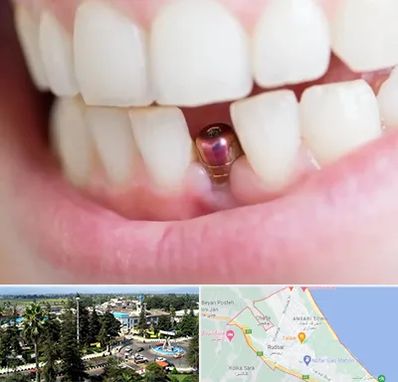 ایمپلنت اقساطی در رودسر