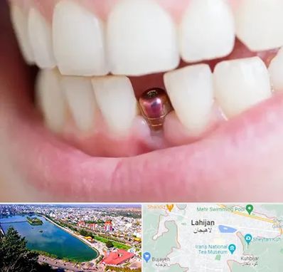 ایمپلنت اقساطی در لاهیجان